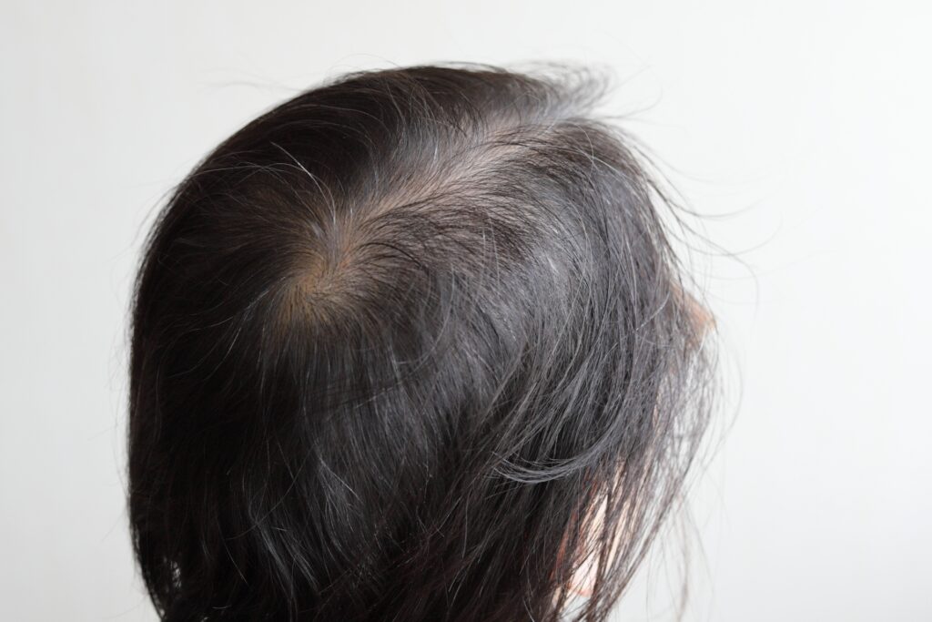 [アセチルテトラペプチド-3]育毛成分のミノキシジルの3倍の育毛効果がある成分